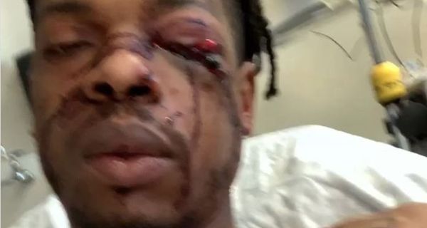 Atlanta Rapper Cooley Shot In The Face, Shows Off Bullet Wounds